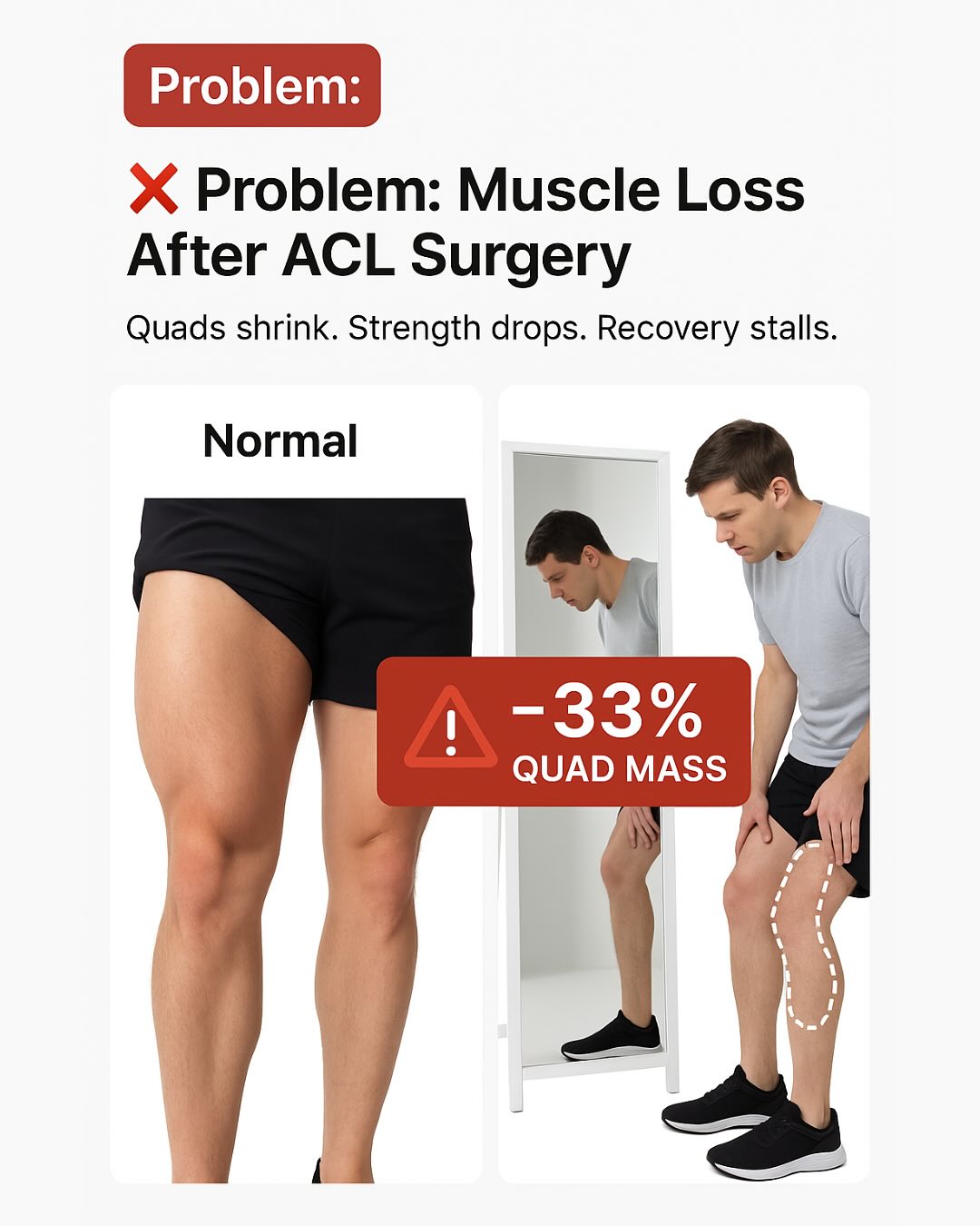 Build Strength Safely After ACL Surgery